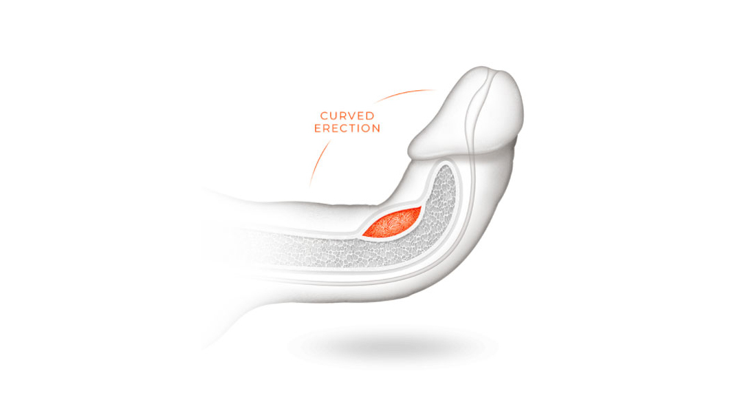 Curved Erection